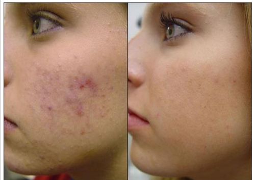 Pimple Treatment In Kanpur