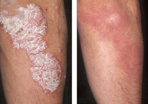 Psoriasis Treatment In Basti