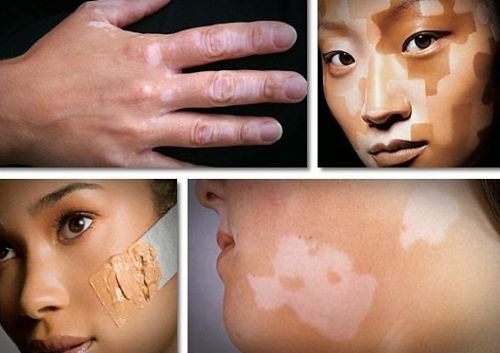 Vitiligo Treatment In Rohania