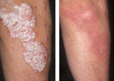 Psoriasis Treatment In Sikraul