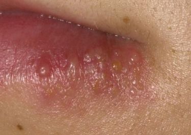 Venereal Disease Treatment In Mau